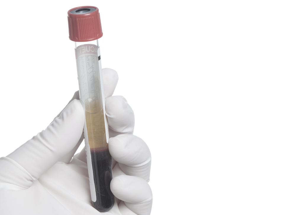 PRP (Rich Platelet Plasma)